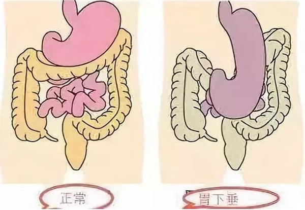 胃下垂吃什么中成药比较好  胃下垂吃什么中成药